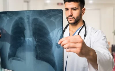 El primer trasplante pulmonar de persona con Fibrosis Quística se realizó en 1983